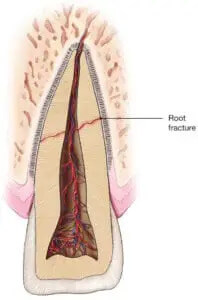 Root-Fracture-198×300-1.jpg
